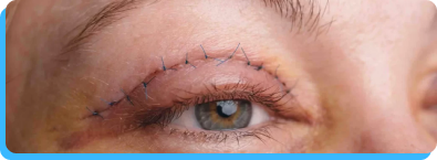 Blefaroplastia