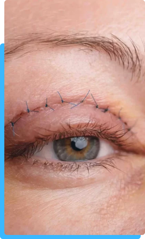 Blefaroplastia