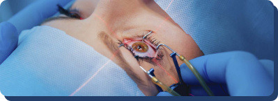 Cirurgia de Catarata